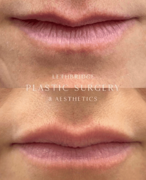 Lip Injections