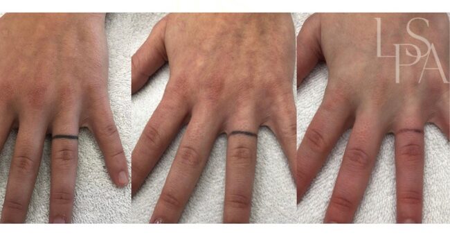 Laser Tattoo Removal in Lethbridge