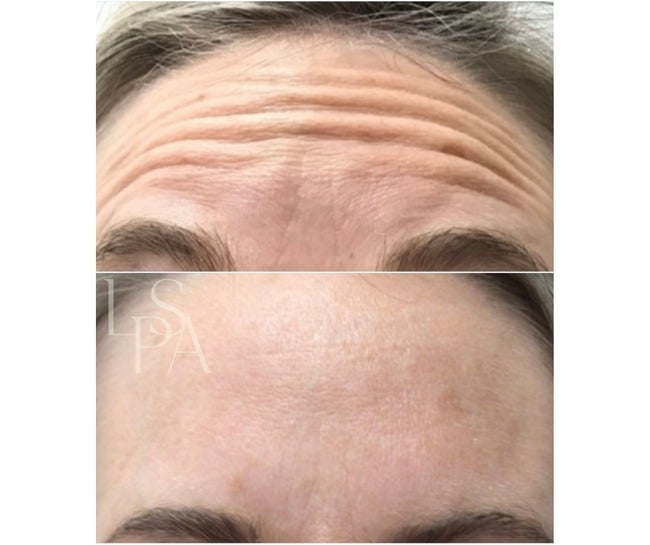 Cosmetic Benefits of Botox in Lethbridge