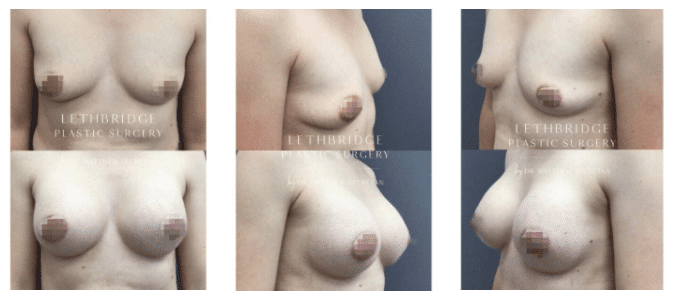 breast augmentation before and after