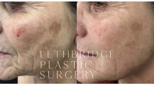 Before and After of skin health on female patient