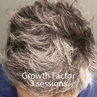 A man's increased hairline after the growth factor treatment